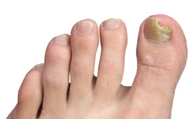 Laser nail therapy for fungal nails, painful nails
